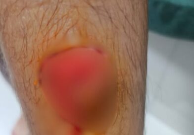 Menino de 11 anos é atacado por cães no Centro de Manhuaçu